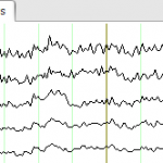 Methoden im Neuromarketing: EEG